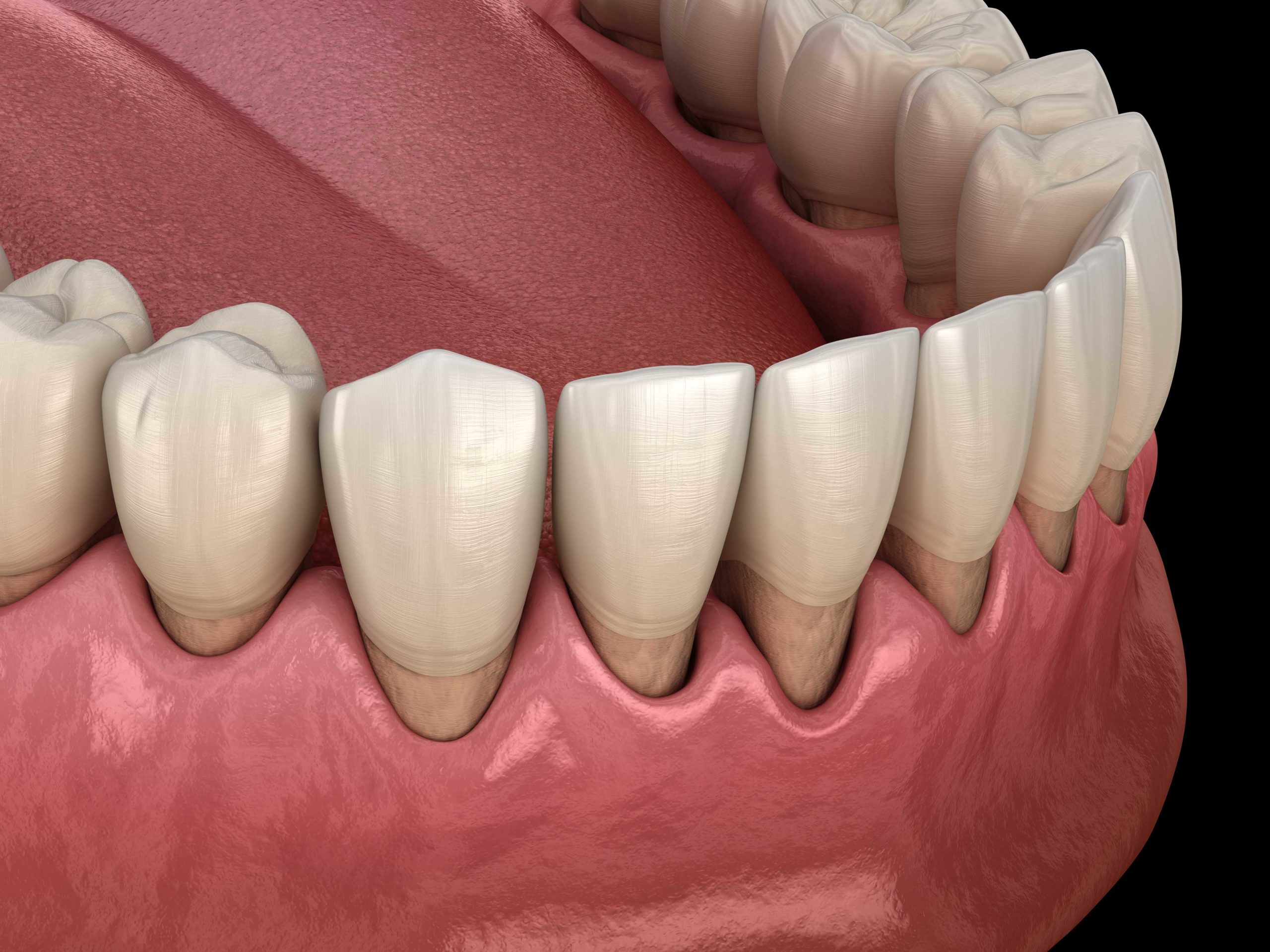 gum-recession-pinhole-surgical-technique-grafting