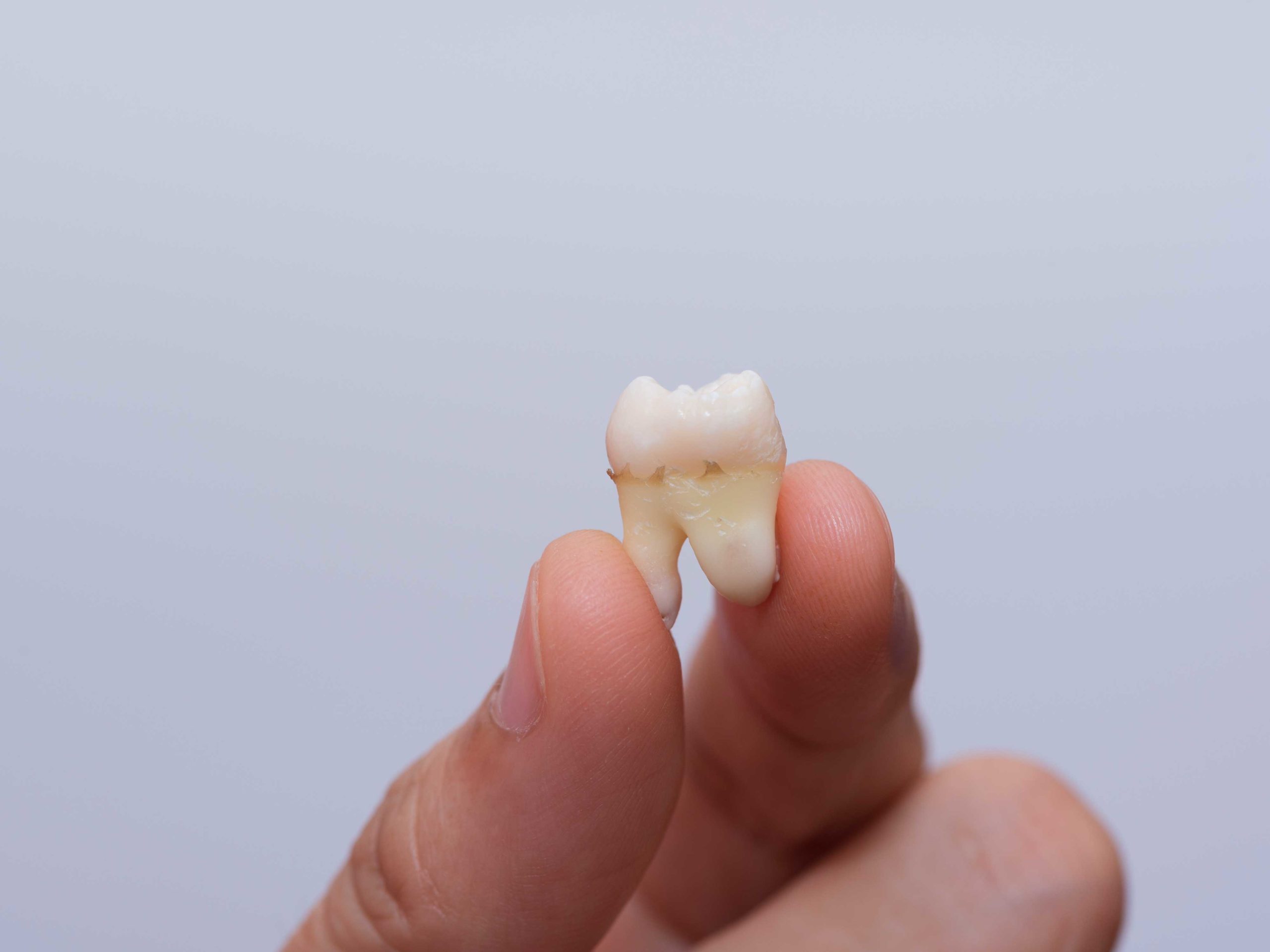 Removal-of-Wisdom-Teeth-Left-Column