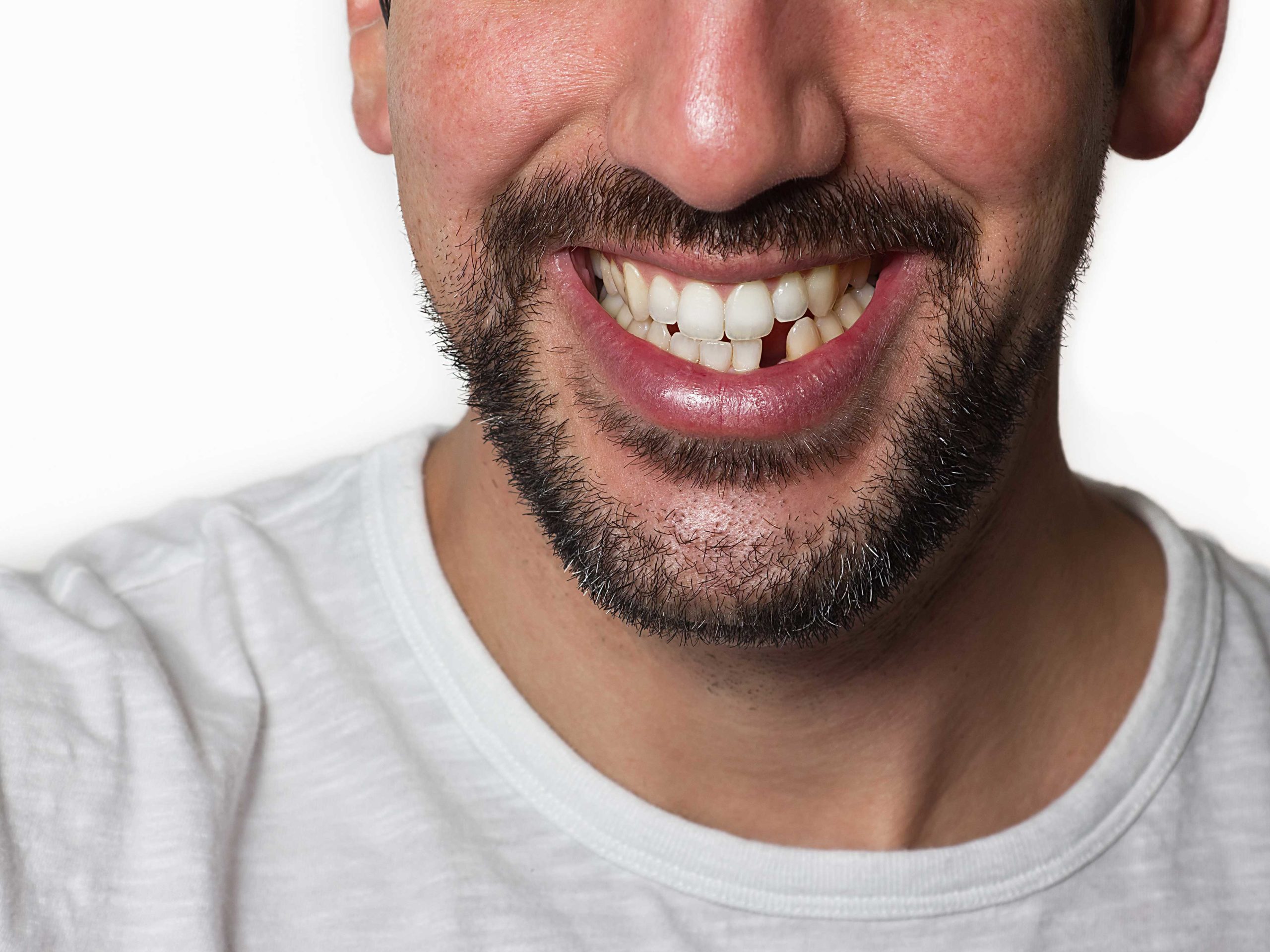Replacing-Missing-Teeth-Right-Column