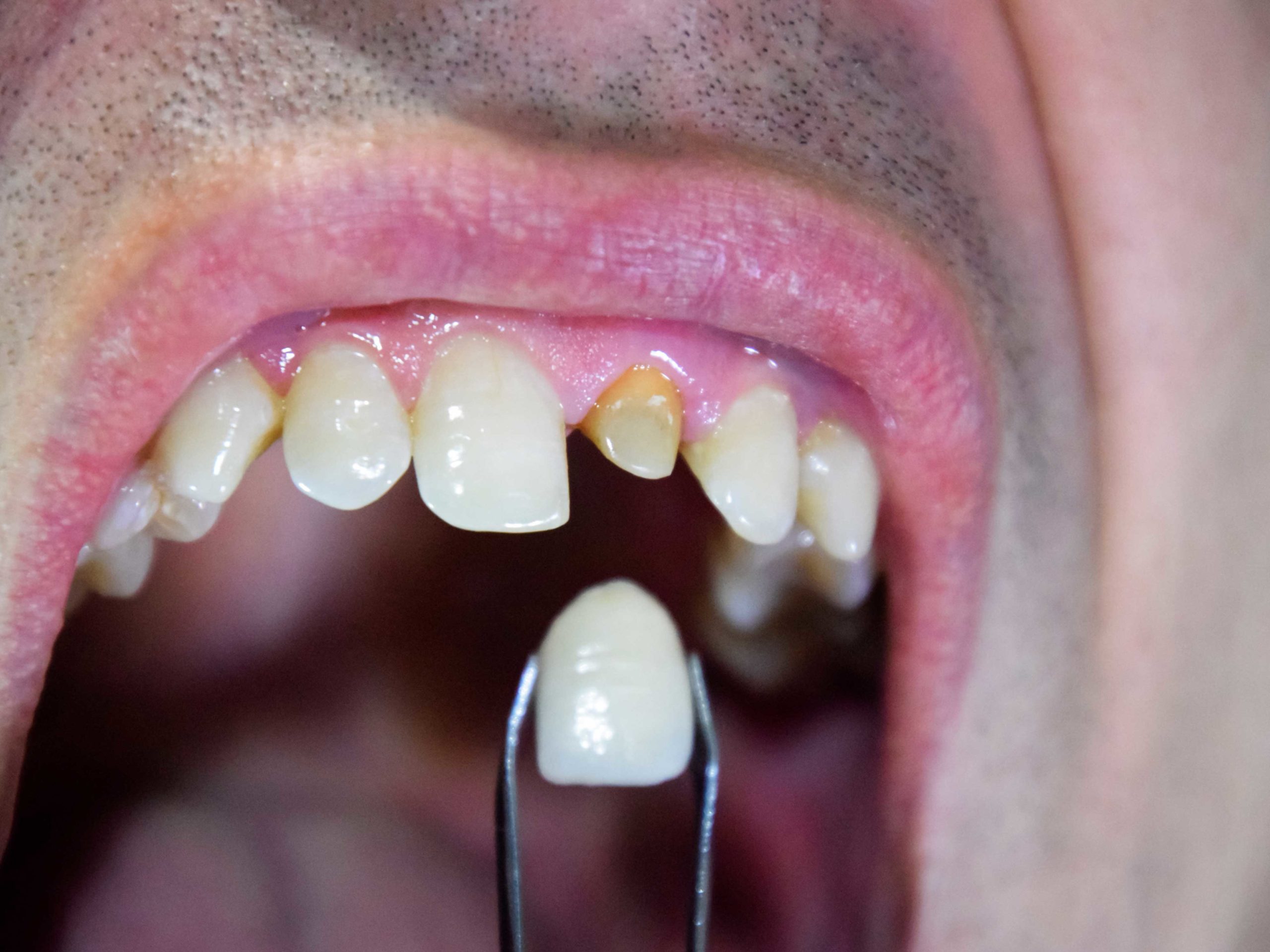 Tooth-Replacement-Right-Column