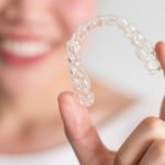 Invisalign braces