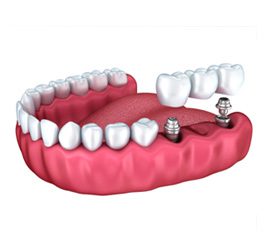 partial-prosthesis
