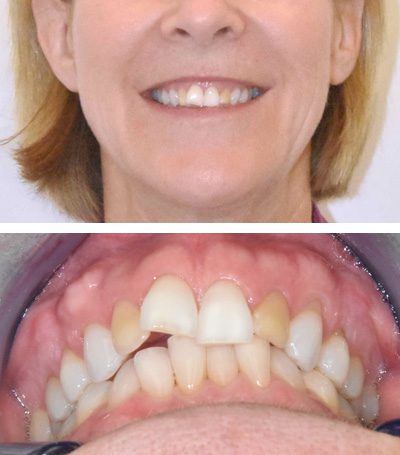 patient-2-invisalign-before-IMG1