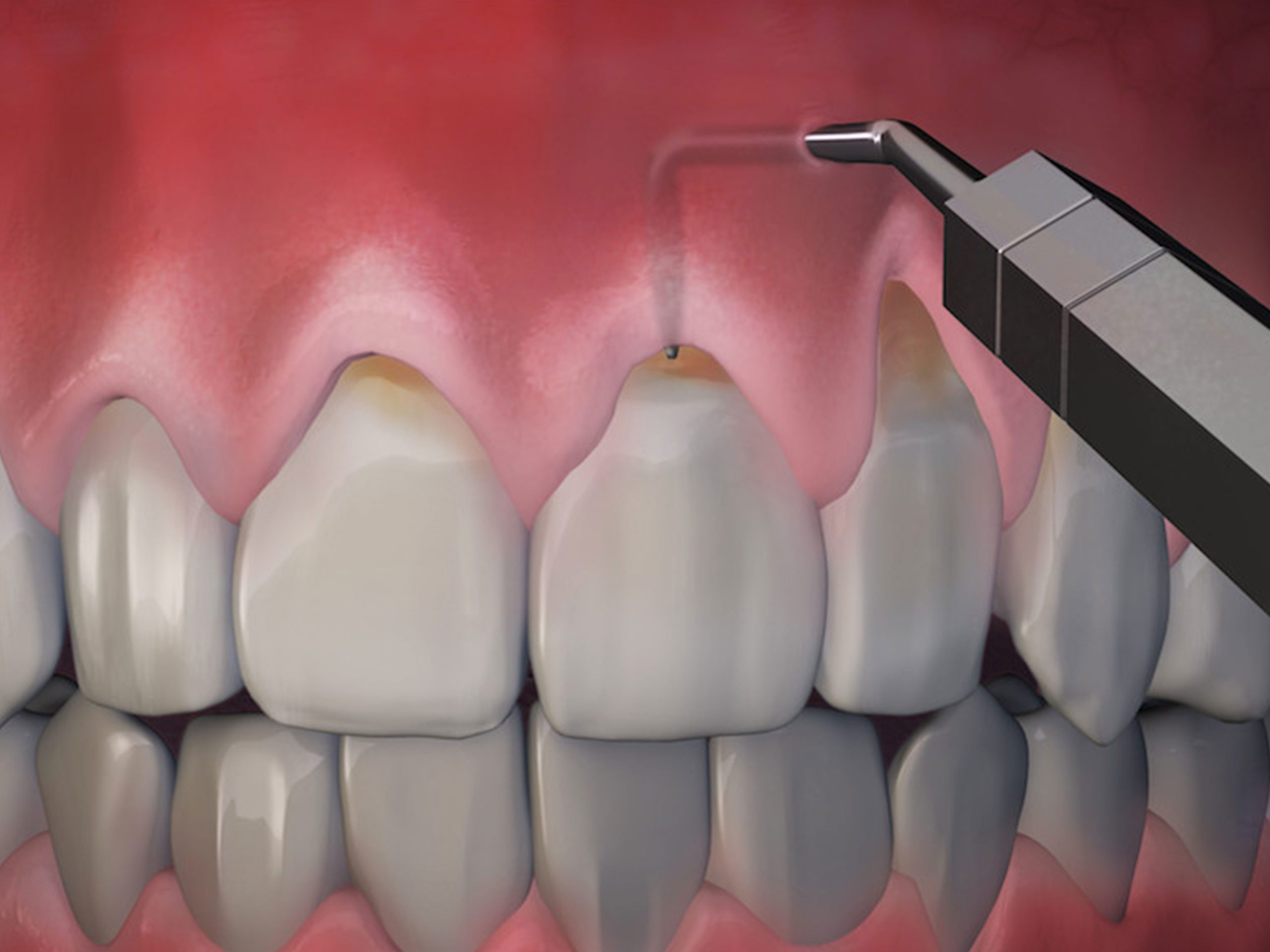 pinhole-surgical-technique