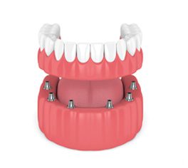 removable-prosthesis