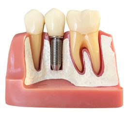 single-prosthesis