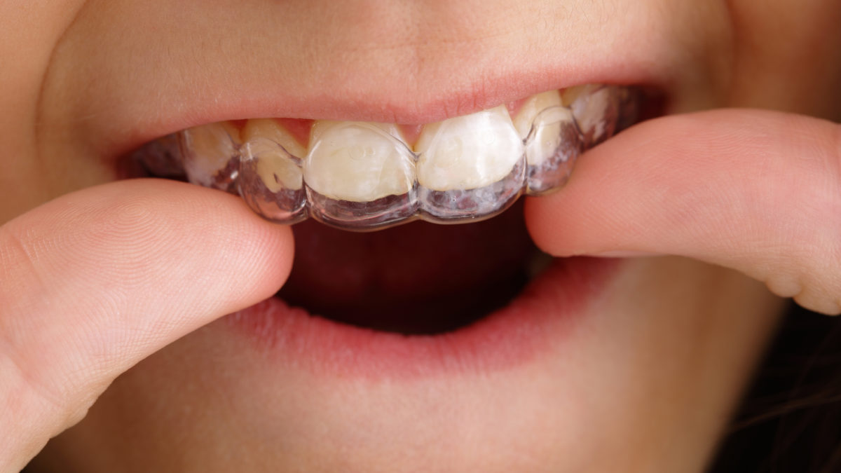 Are you a Good Candidate for Invisalign Braces?