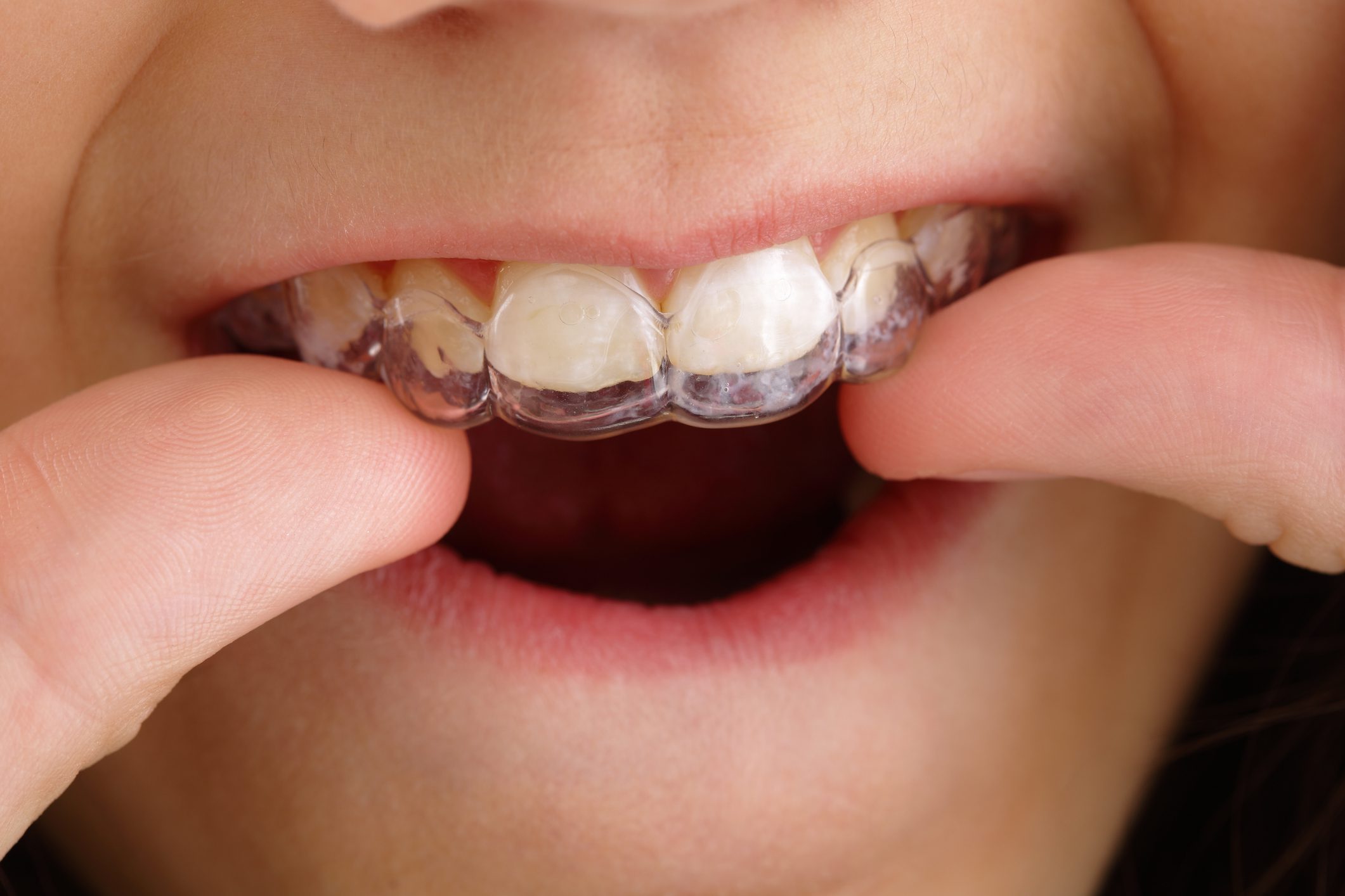 Are you a Good Candidate for Invisalign Braces?