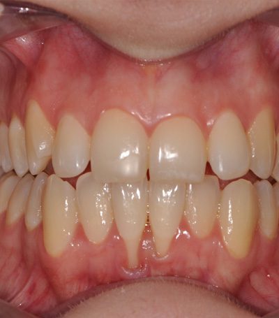 sophie-merged-gum-recession-before-and-after