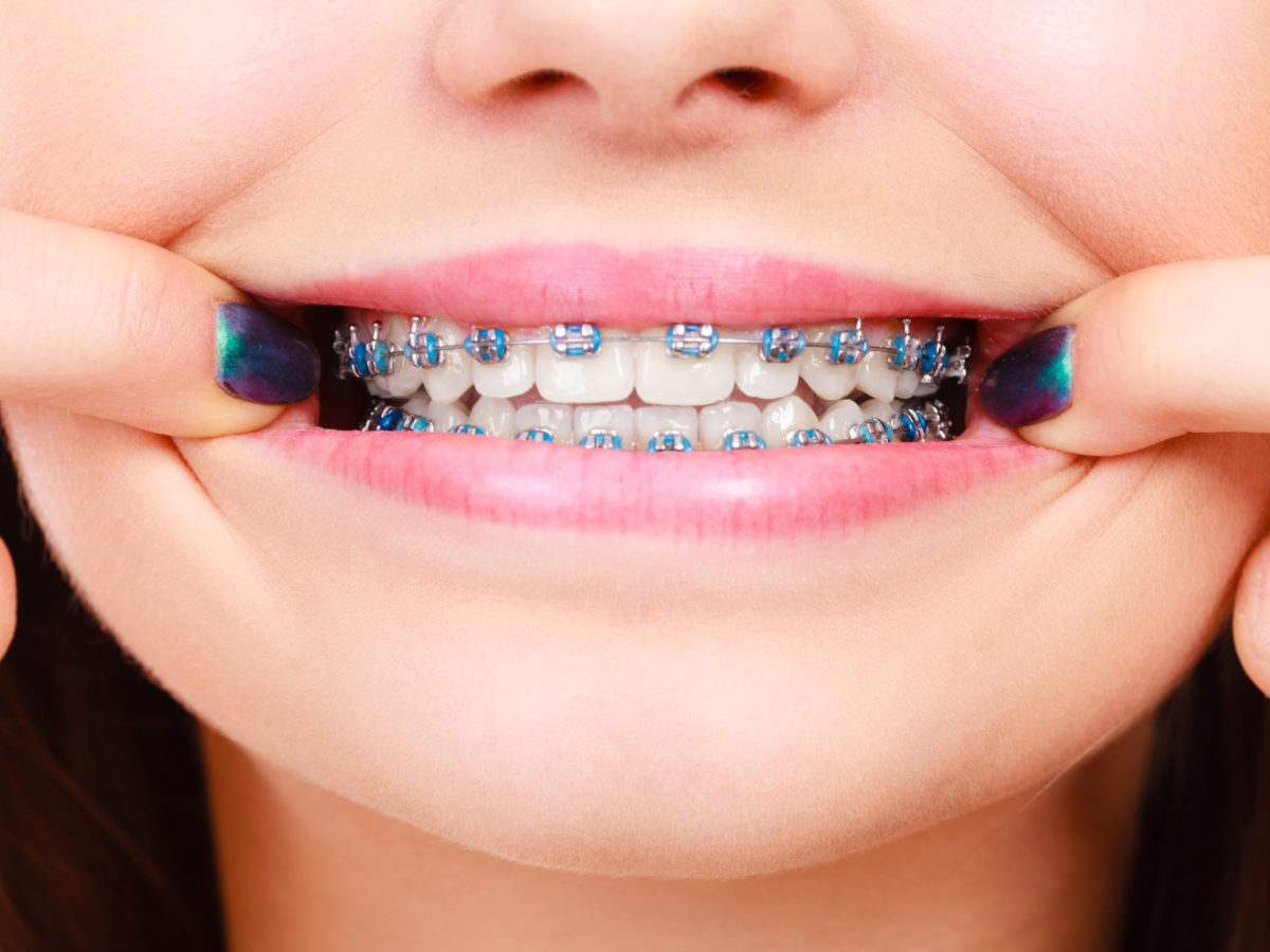 How Do Fast Braces Work to Accelerate Orthodontics?