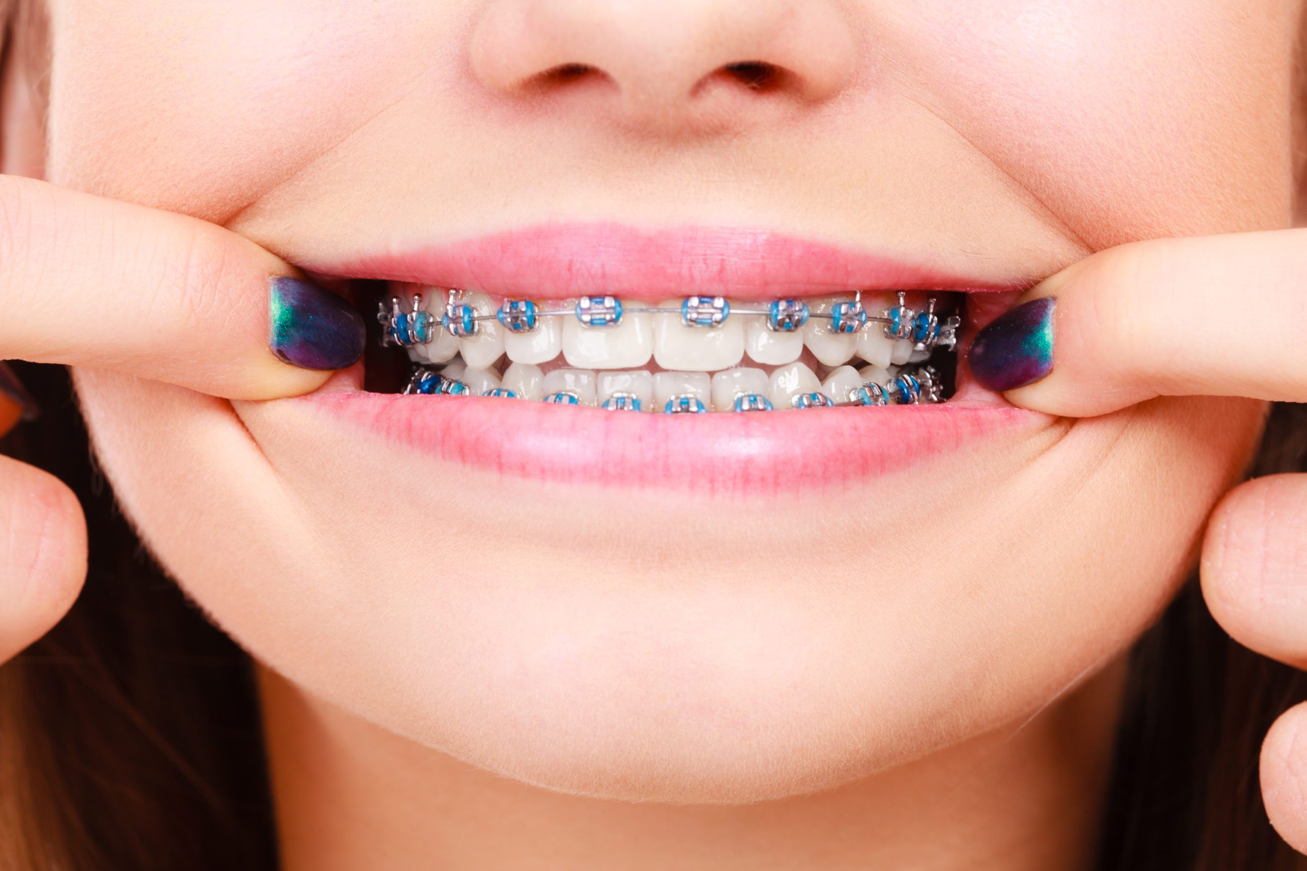 The Ultimate Guide of 12 Different Types of Braces and Clear Aligners