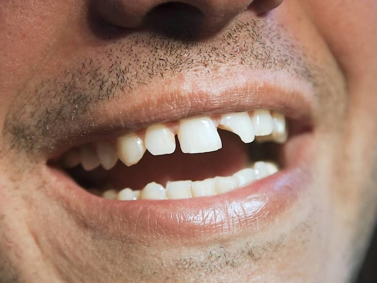 Several Methods of Teeth Repair