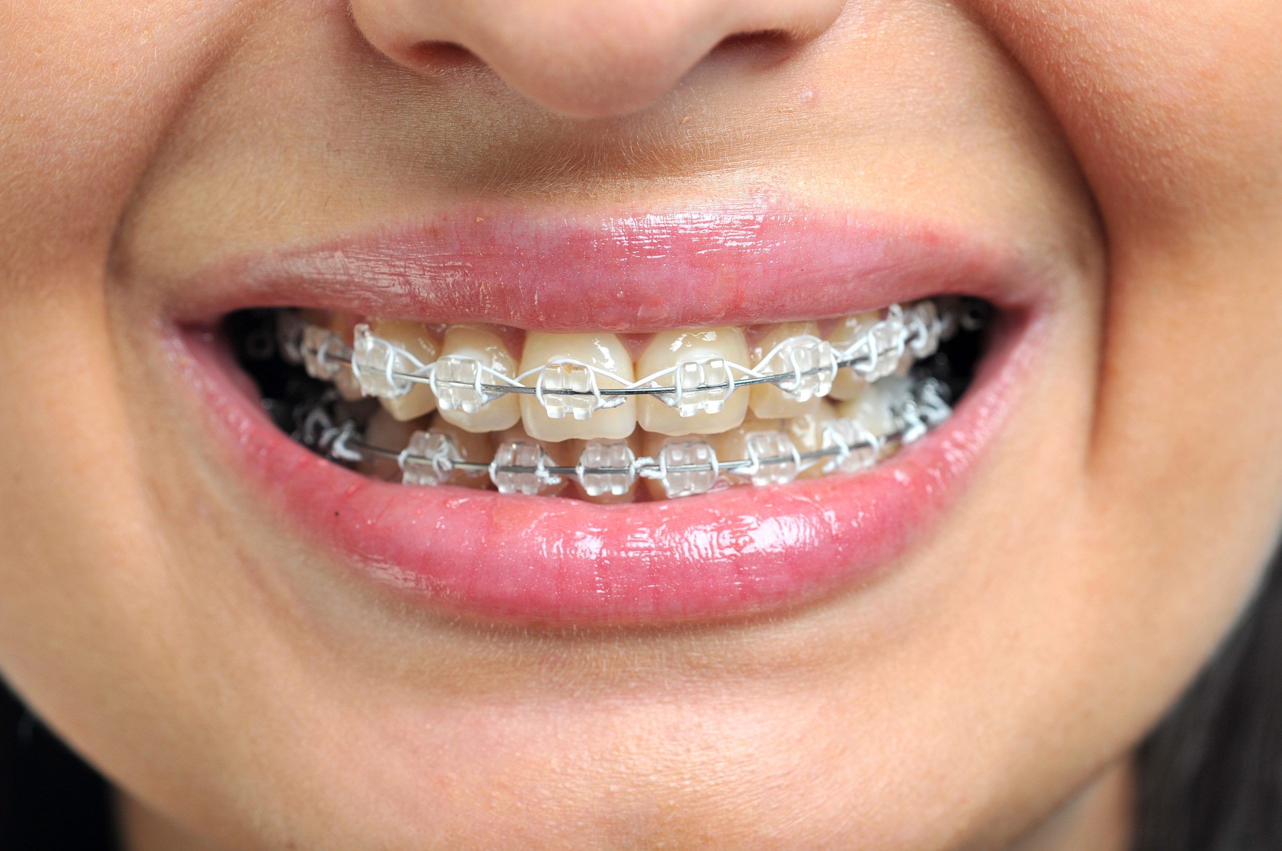 The Biggest MIstake You Can Make with Invisalign Braces