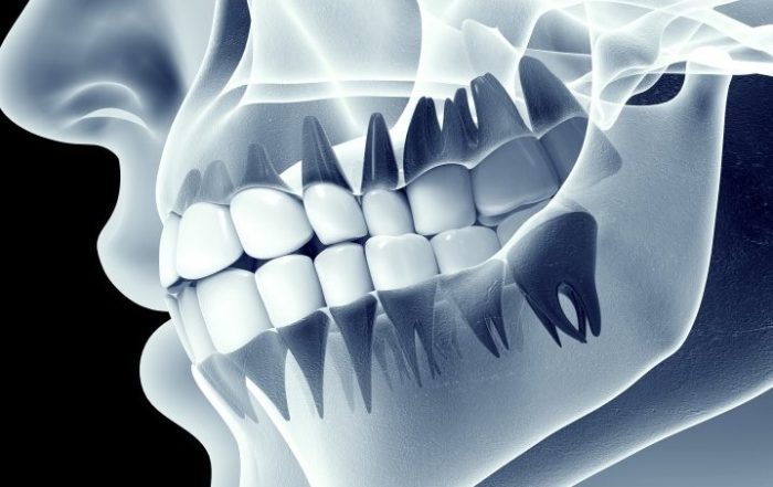understanding how we lose jaw bone density