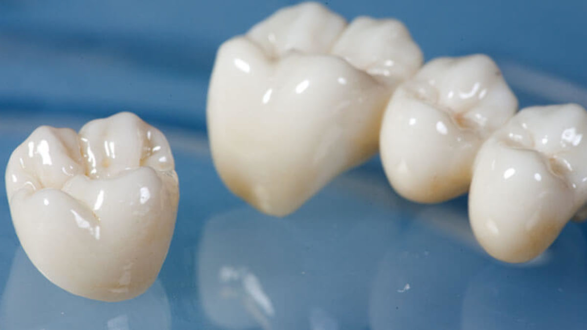A Complete Guide to Temporary Tooth Fillings