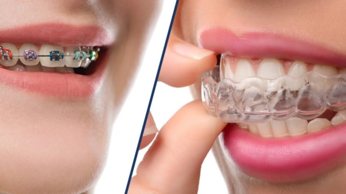 The benefits of space maintainers and clear braces in preventing dental  issues