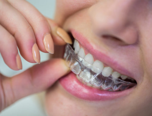 Braces Again? Are You Suffering from Orthodontic Relapse?