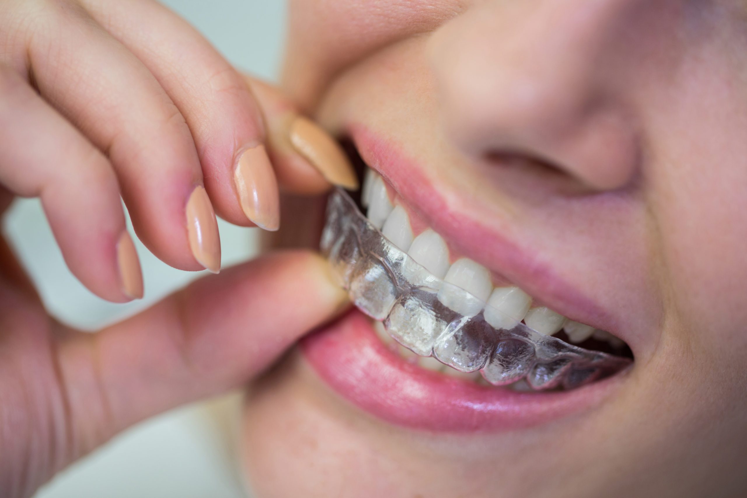 5 Things You Must Know Before Trying Invisible Braces