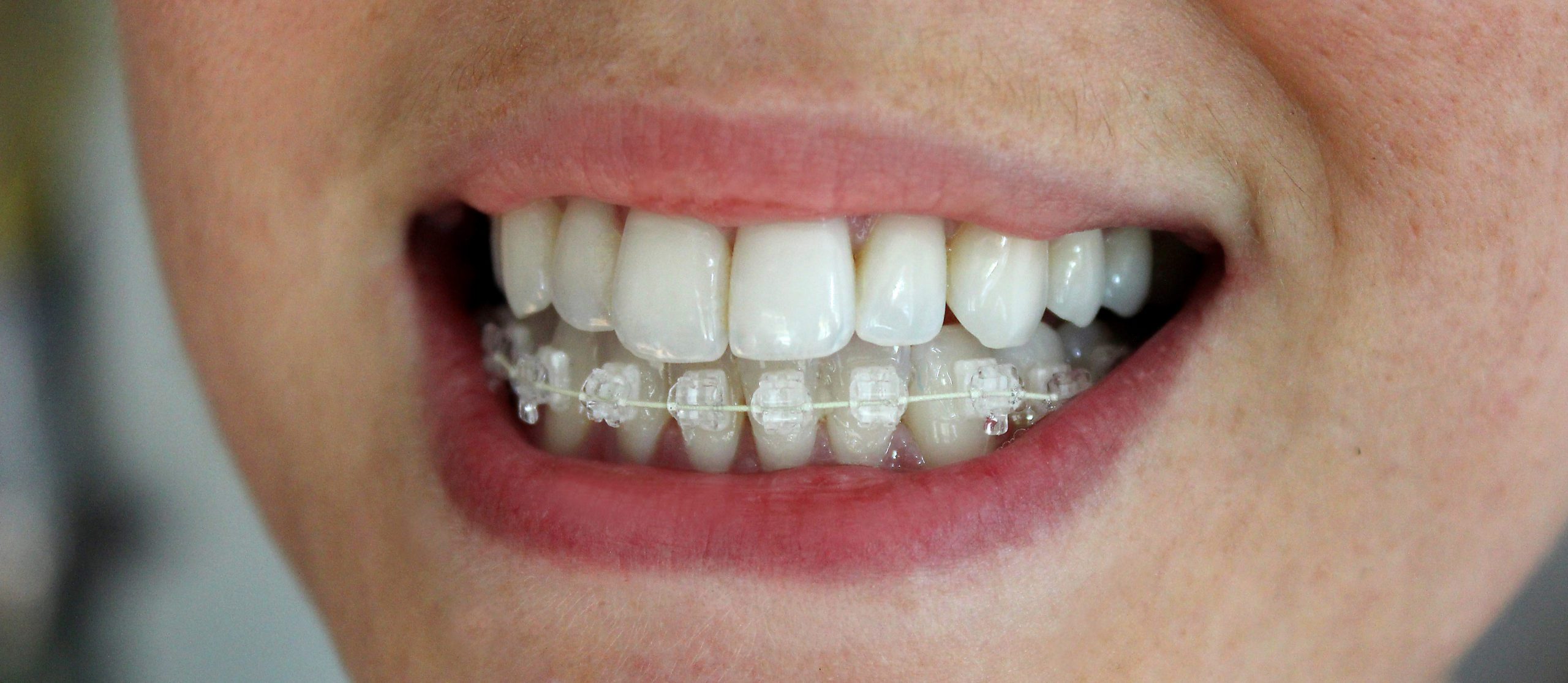 Invisible Braces: Types, How They Work & Cost (Want a Straight Smile?)