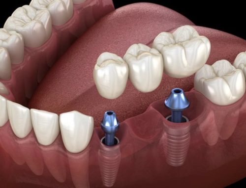 Understanding Dental Bridges