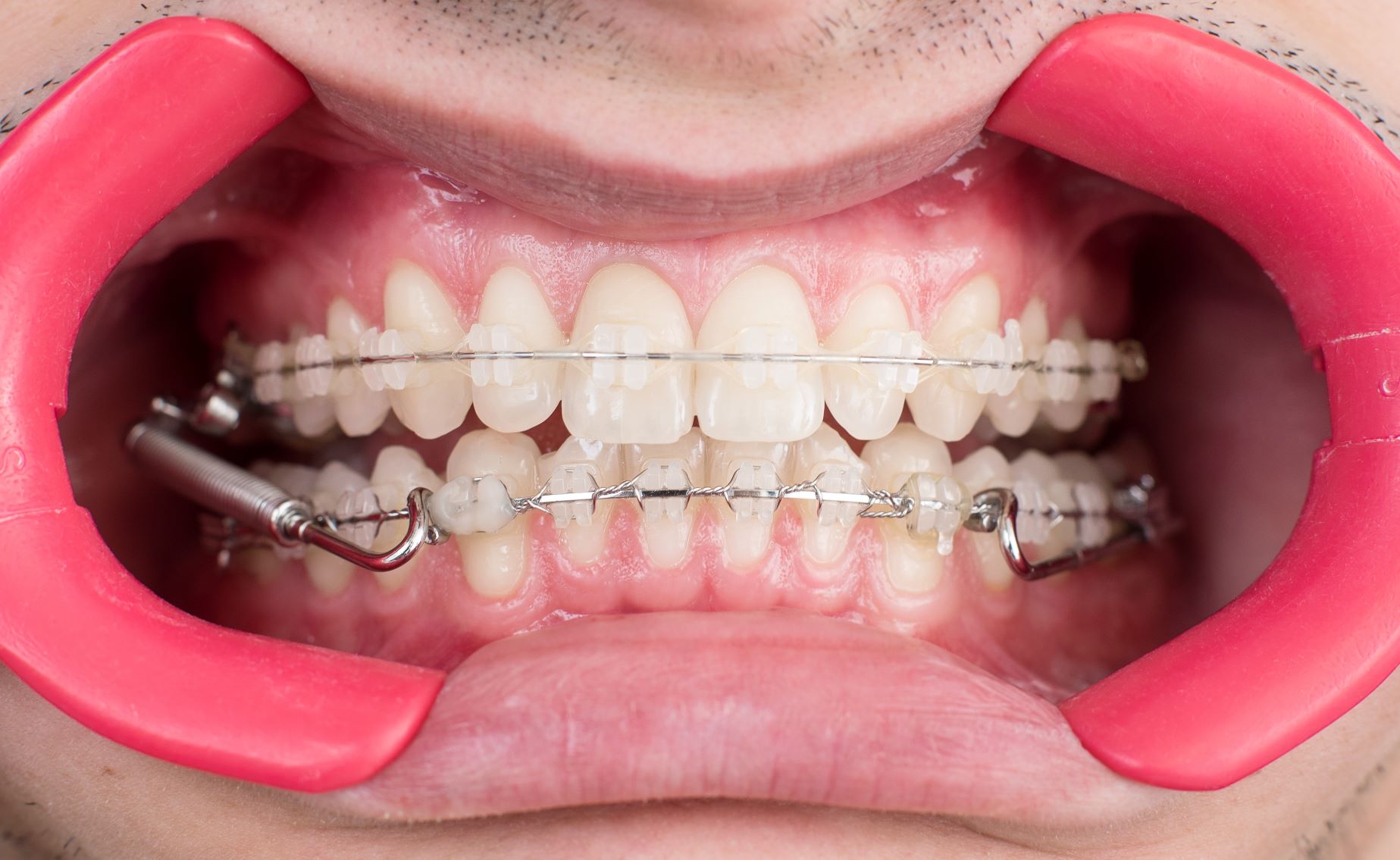 Clarity™ Ceramic Brackets, Dentist, Pershing Orthodontics