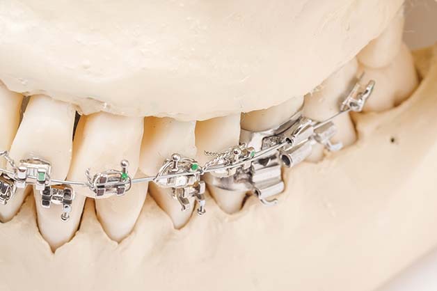 Metal Braces For Orthodontic Treatment & Straighter Teeth