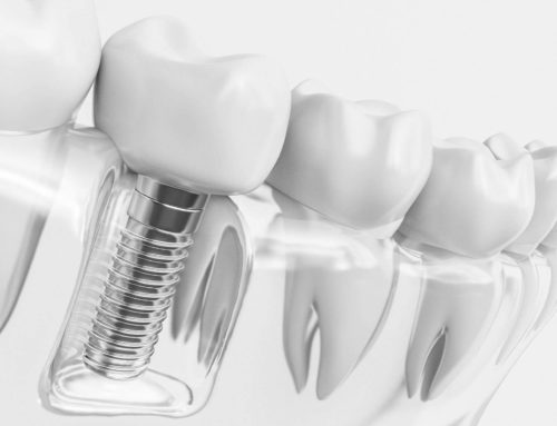 Implants & Tooth Replacements