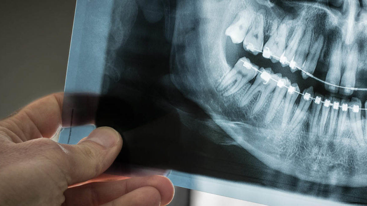 Fun Facts About Wisdom Teeth