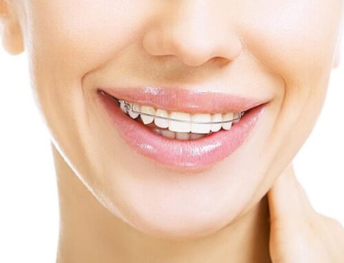 Understanding Dental Retainers