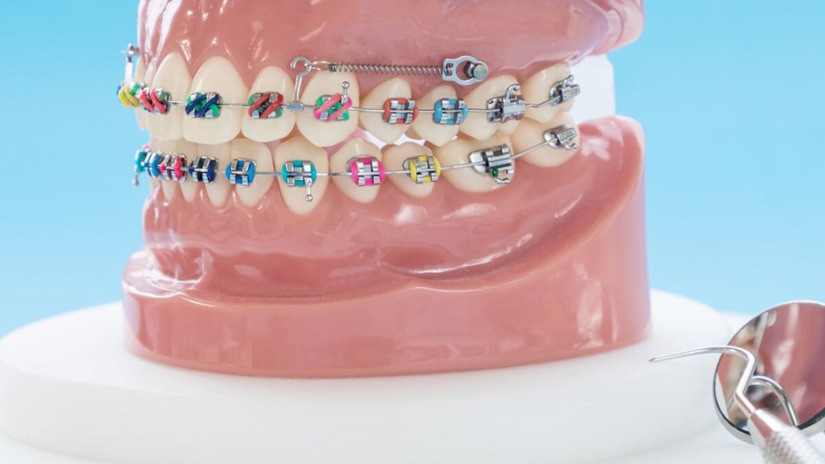 SPEED System Orthodontics