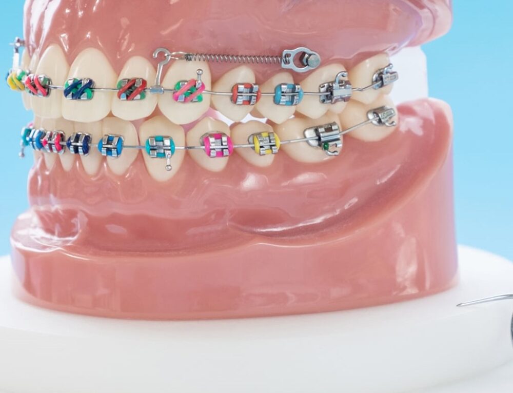 Temporary Anchorage Devices (TAD) Can Help Braces Procedures