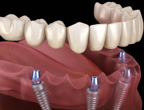 Innovations in Dental Implants