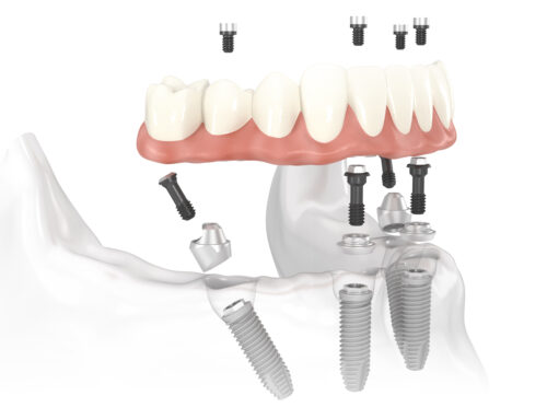 Immediate vs Delayed Placement Implants